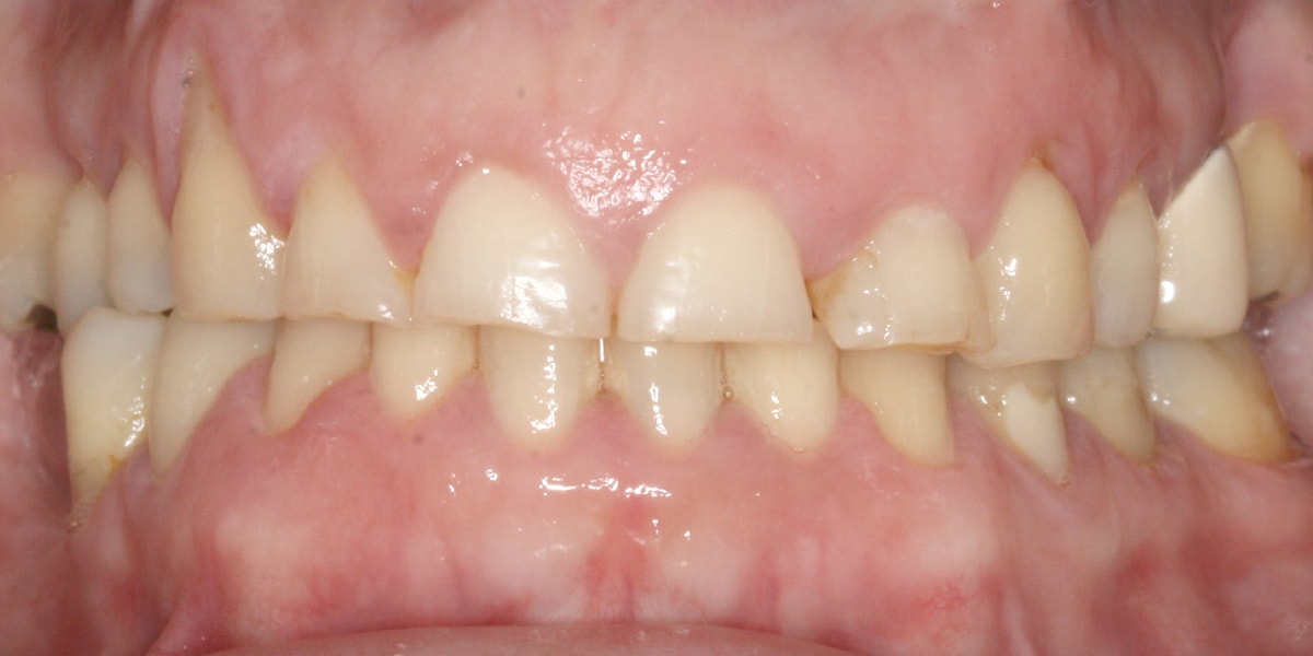 Aprietas los dientes? Conoce sobre el Bruxismo dental - Clínica Dental  Gramadent