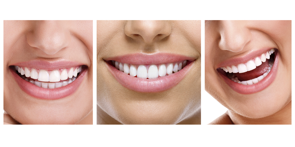 Vástago FALSO desagüe Diseño de sonrisas - Clínica Dental Gramadent