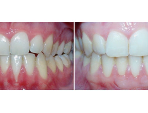 recesion gingival