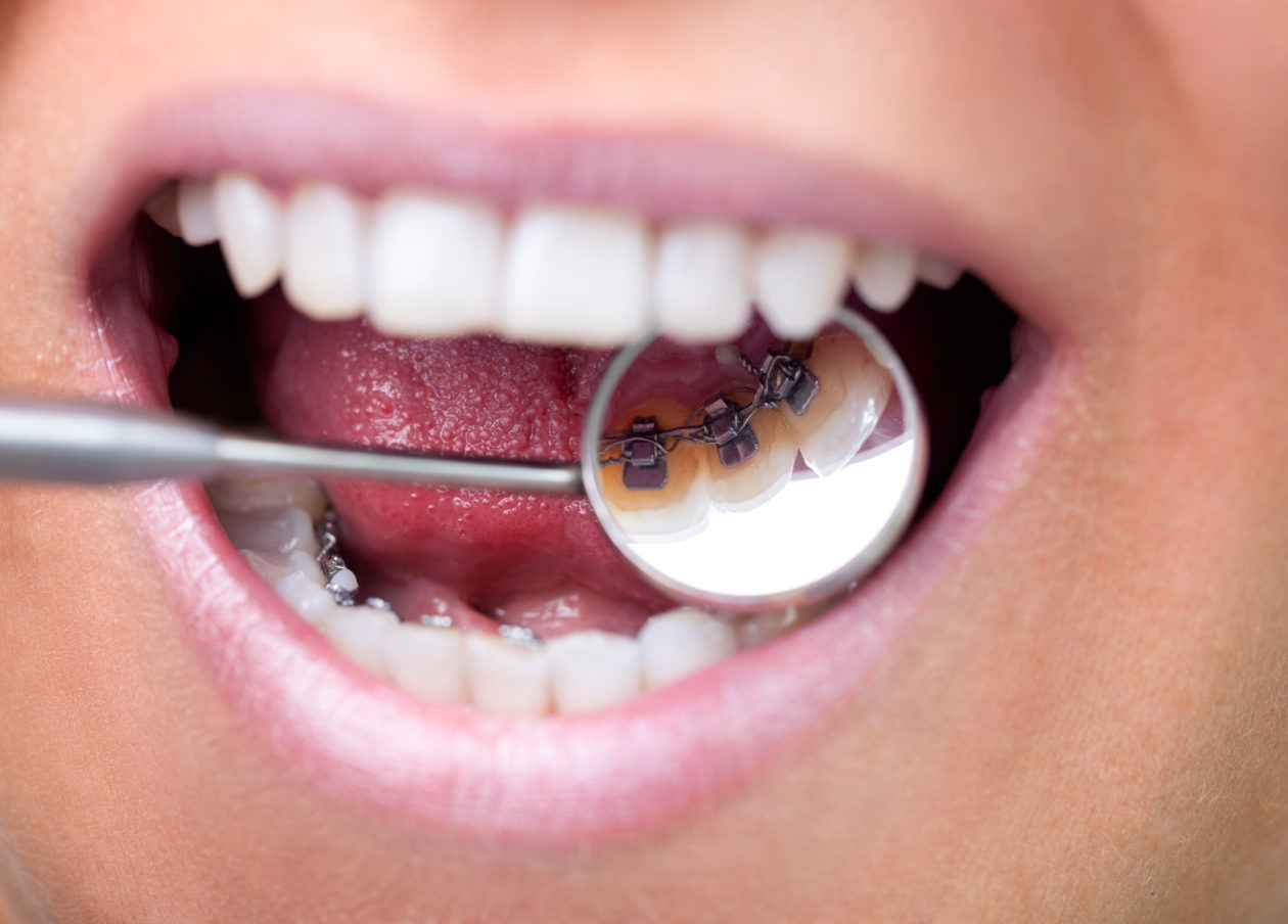 Ortodoncia lingual: en qué consiste y cuáles son sus ventajas - Clínica Dental Gramadent