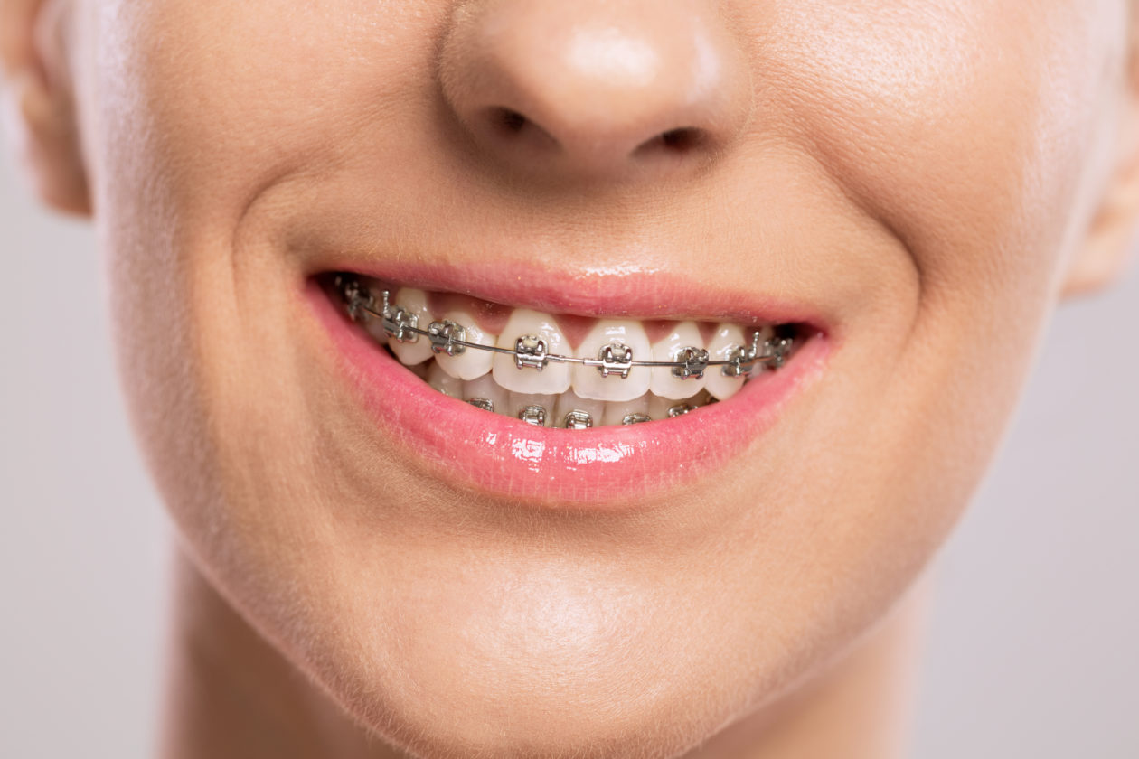 Beneficios de la ortodoncia