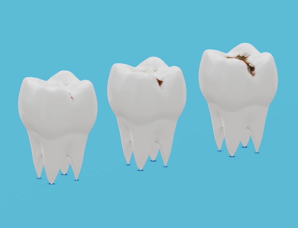 Las etapas de la caries — Odontologic