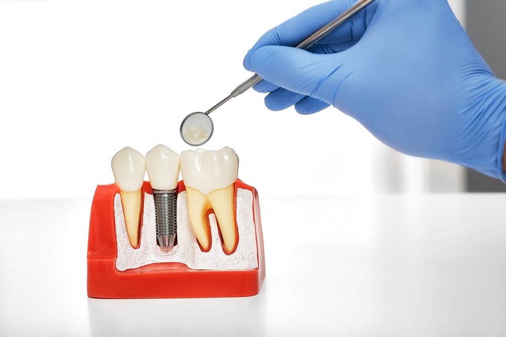 Limpieza de implantes dentales – Seda dental, irrigador y otros métodos