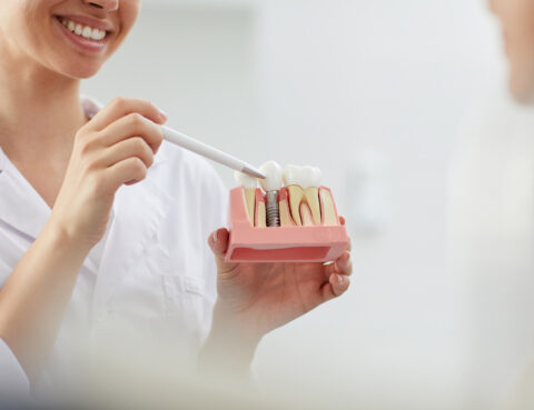 ventajas de los implantes dentales